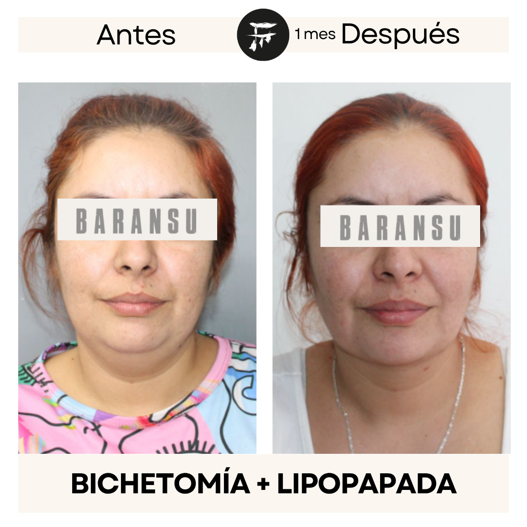 lipo de papada 2