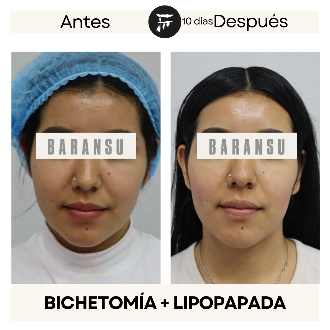lipo de papada 3