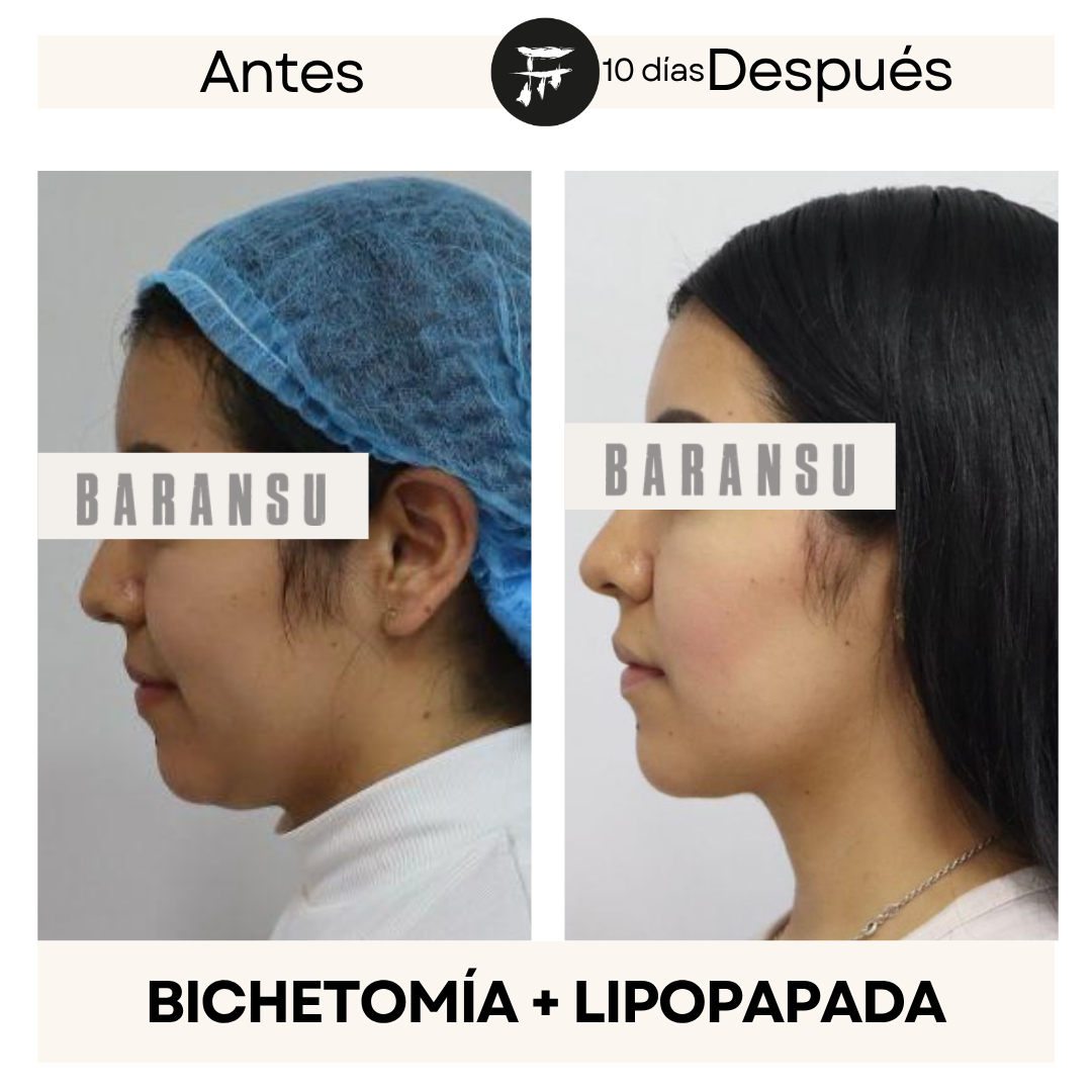 lipo de papada 4