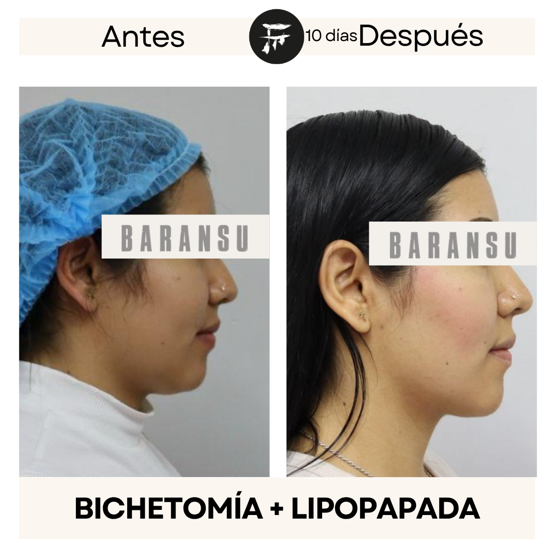 lipo de papada 5