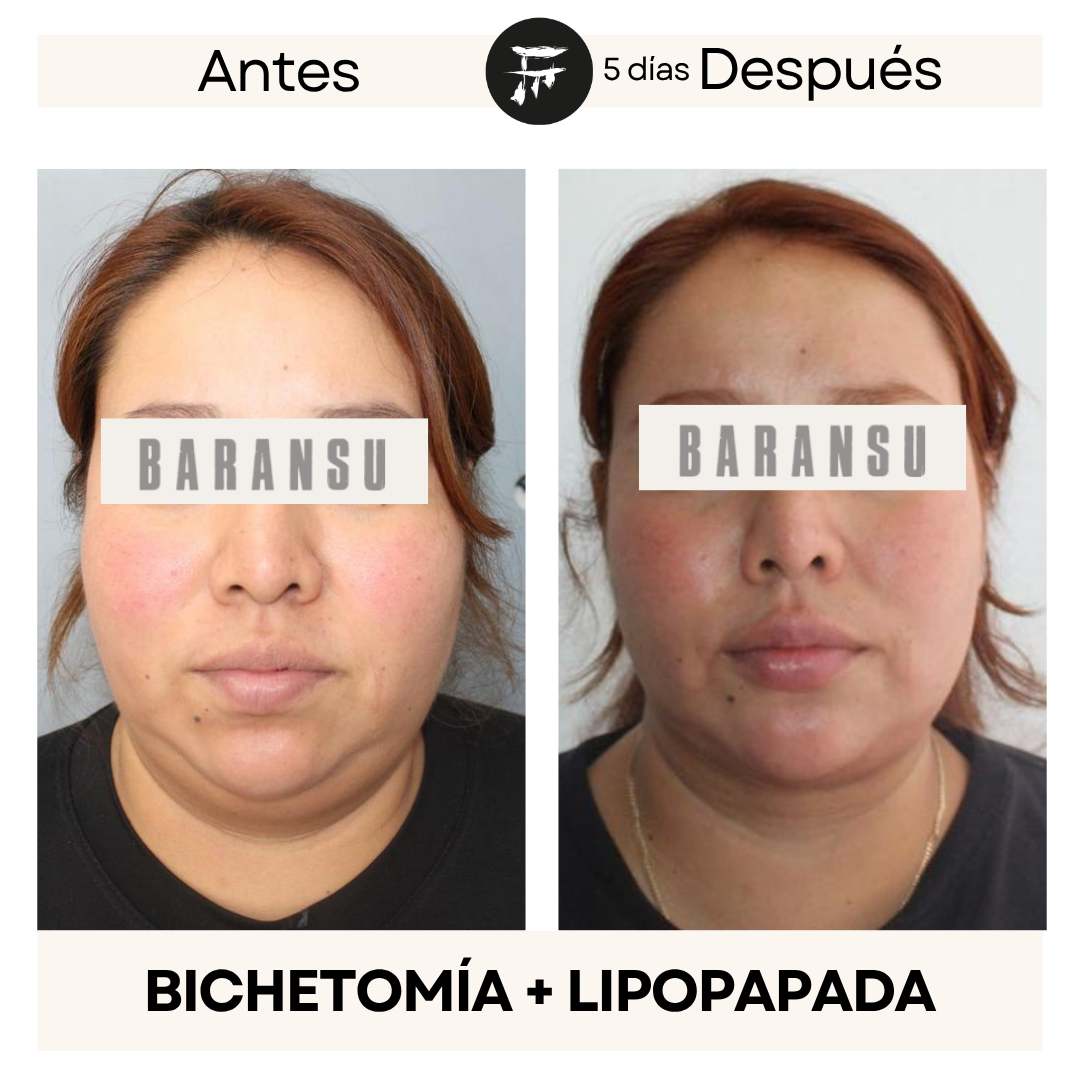 lipo de papada 6