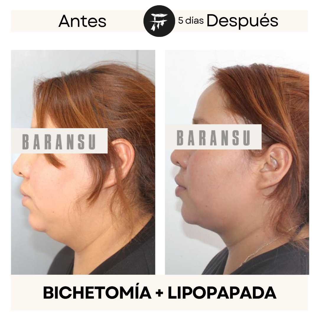 lipo de papada 7