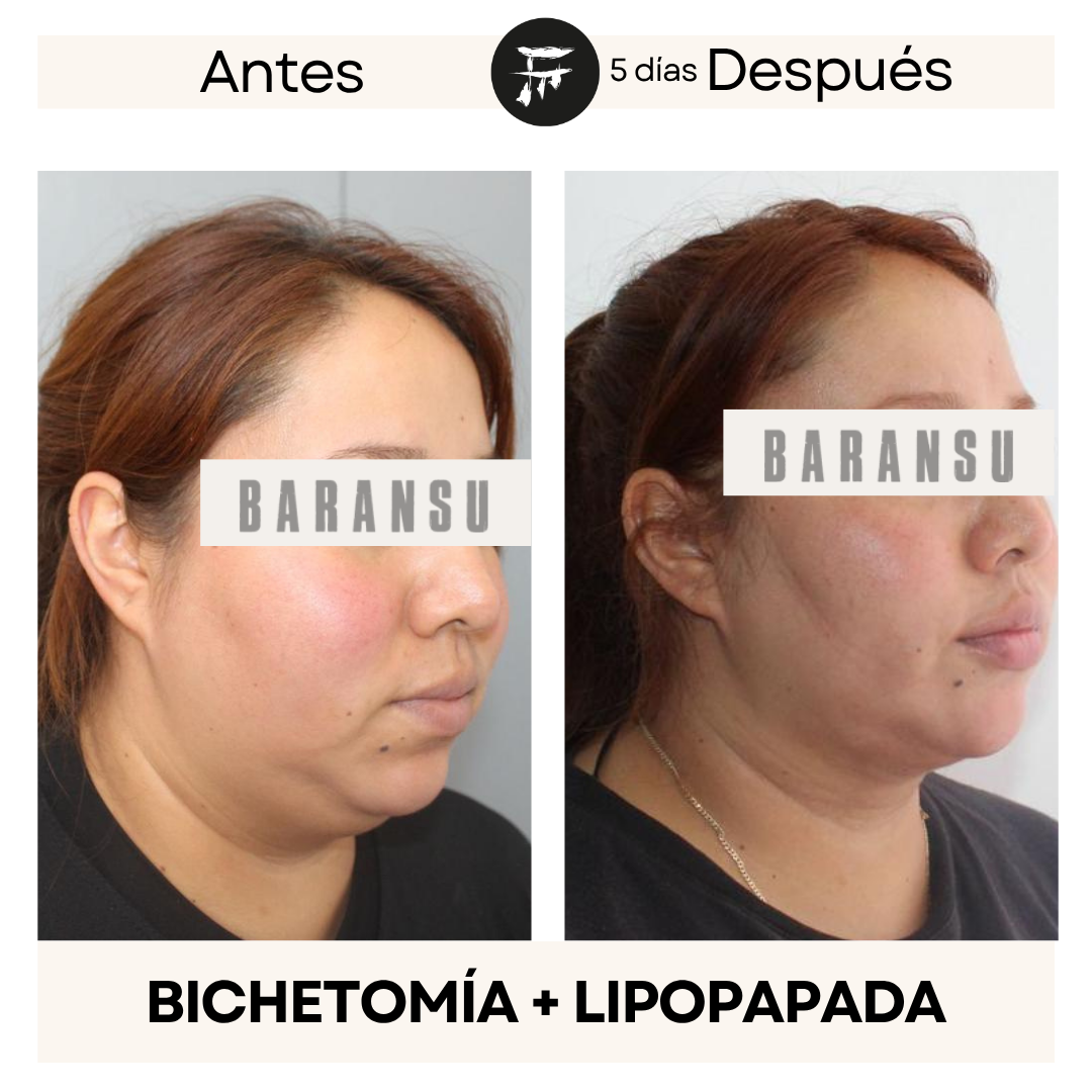 lipo de papada 8