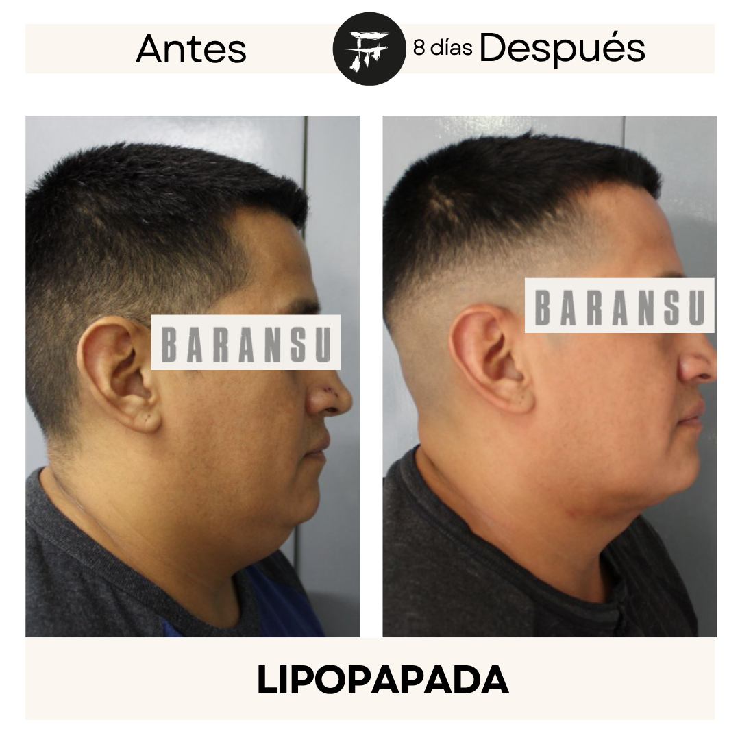 lipo de papada 9