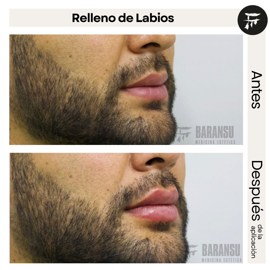 relleno de labios 2