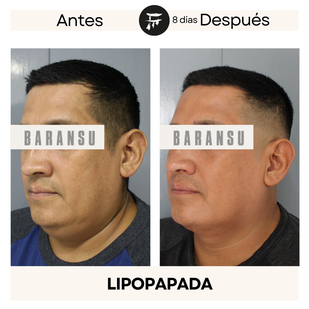 lipo de papada 10