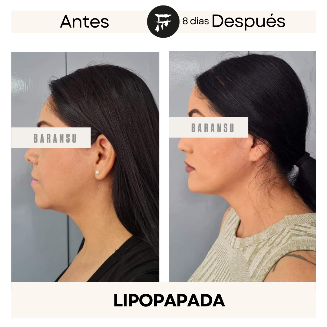 lipo de papada 12
