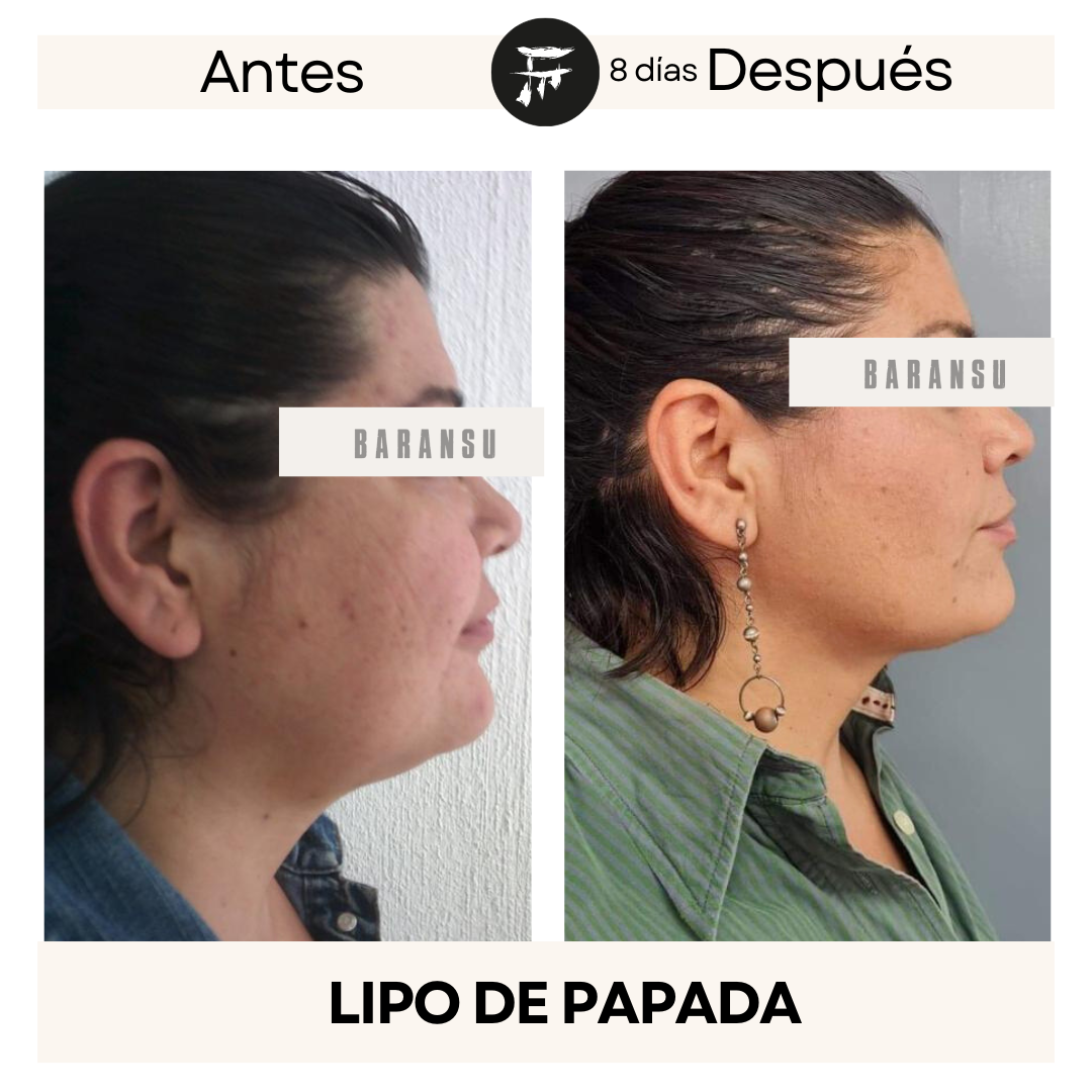lipo de papada 13
