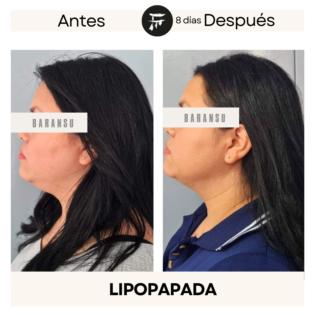 lipo de papada 14