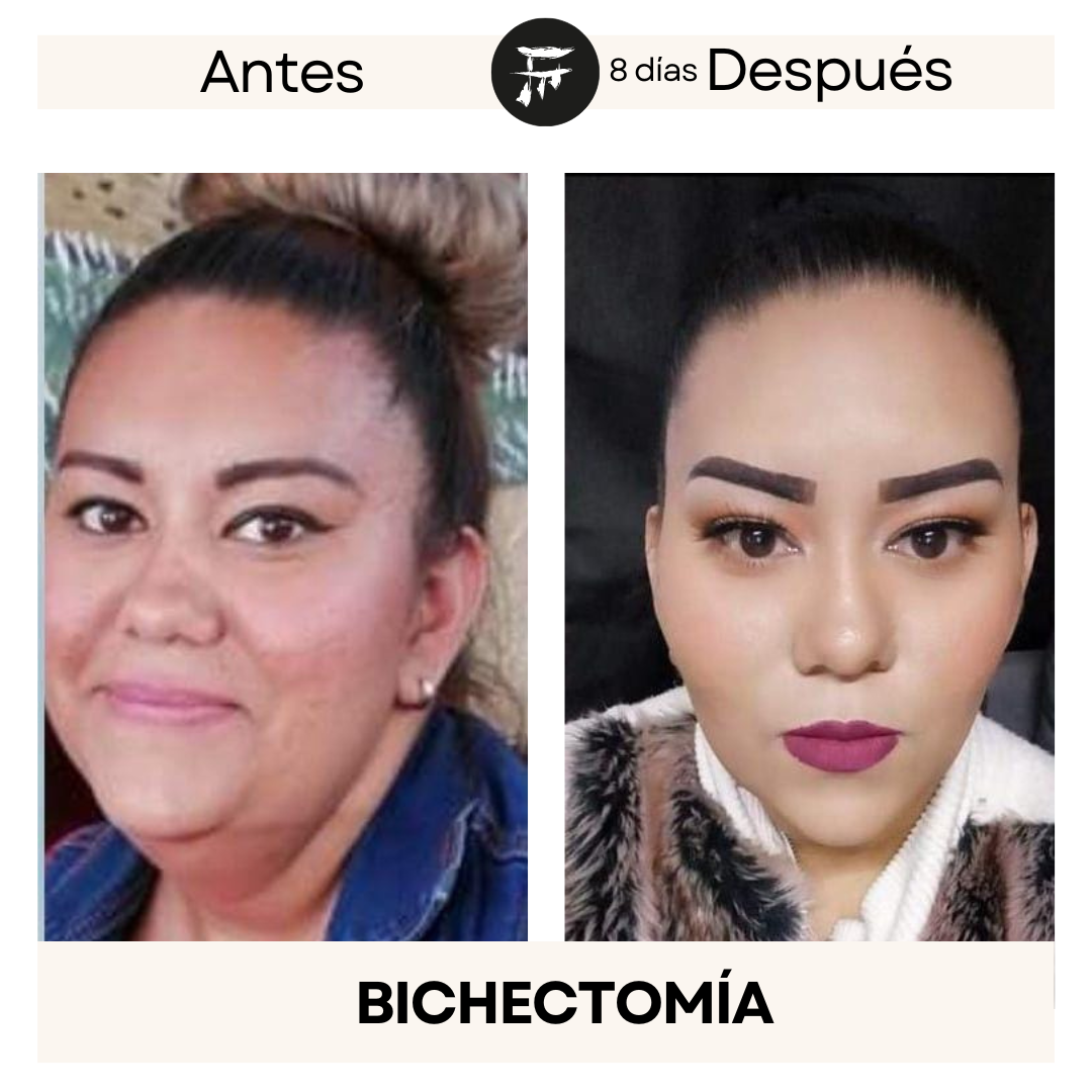 bichectomia 7
