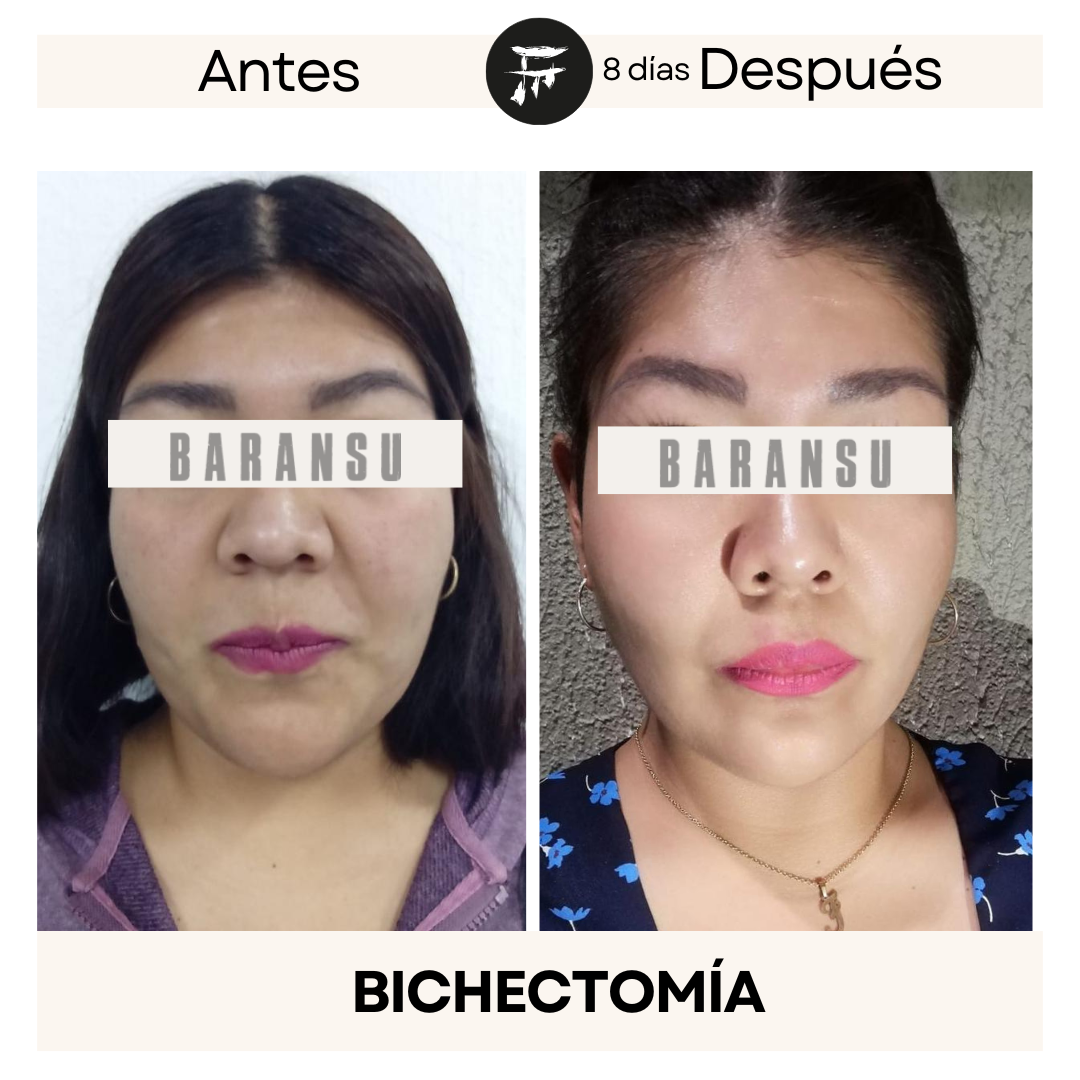bichectomia 8