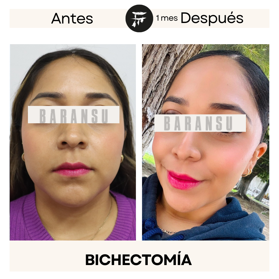 bichectomia 9