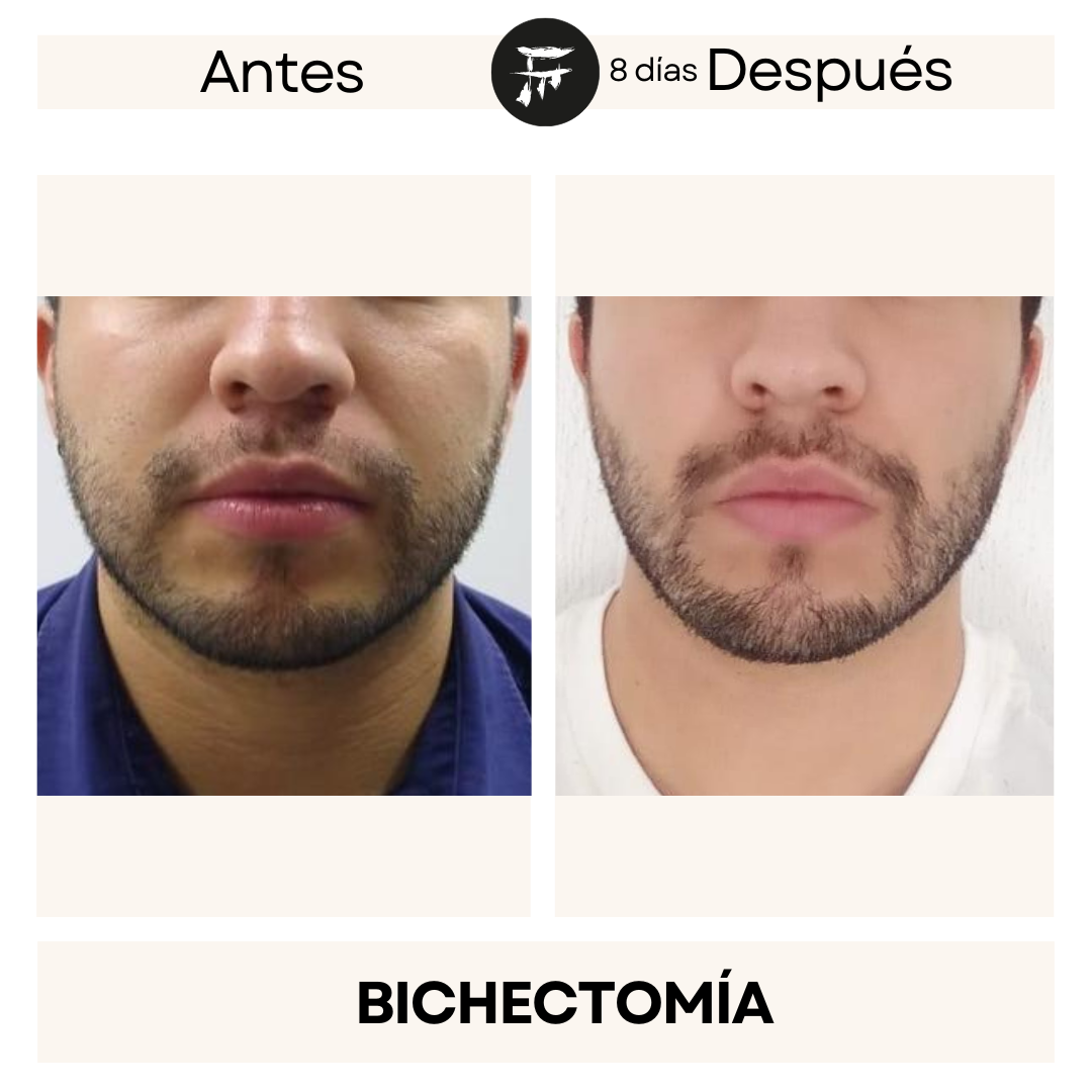 bichectomia 10