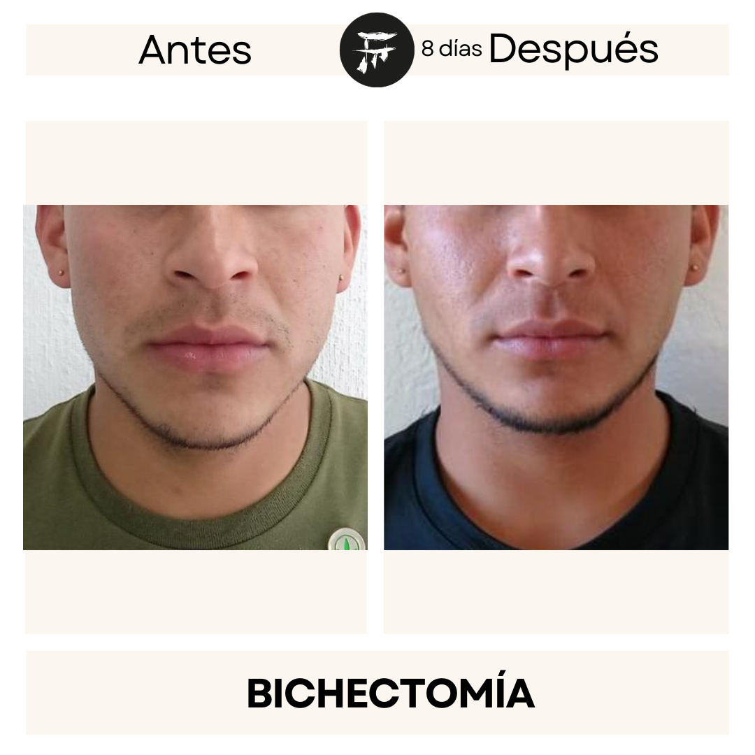 bichectomia 11