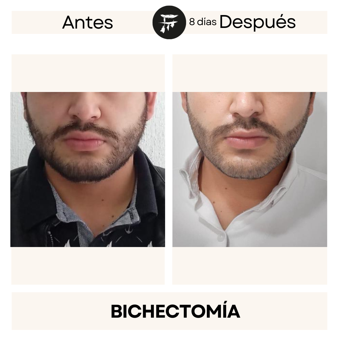 bichectomia 12