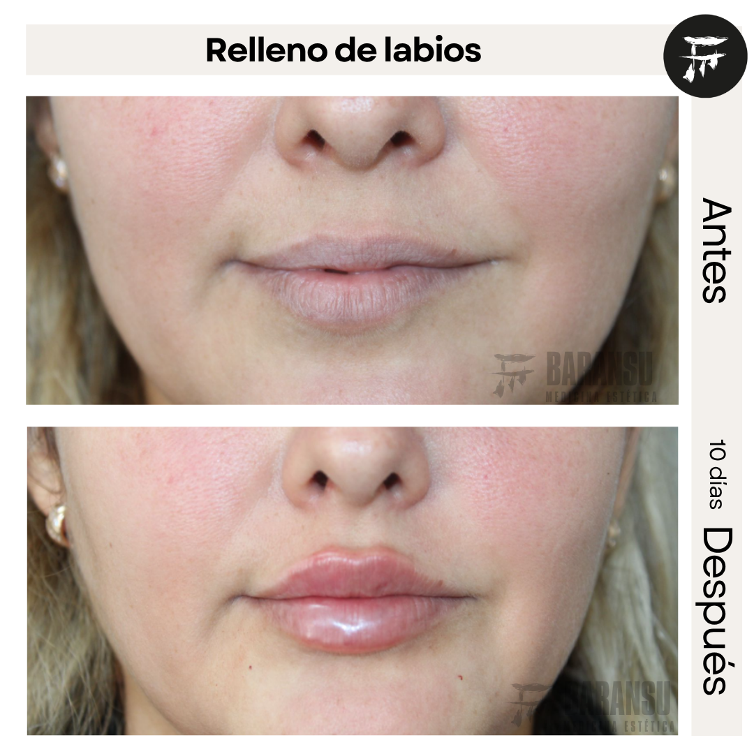 relleno de labios 4