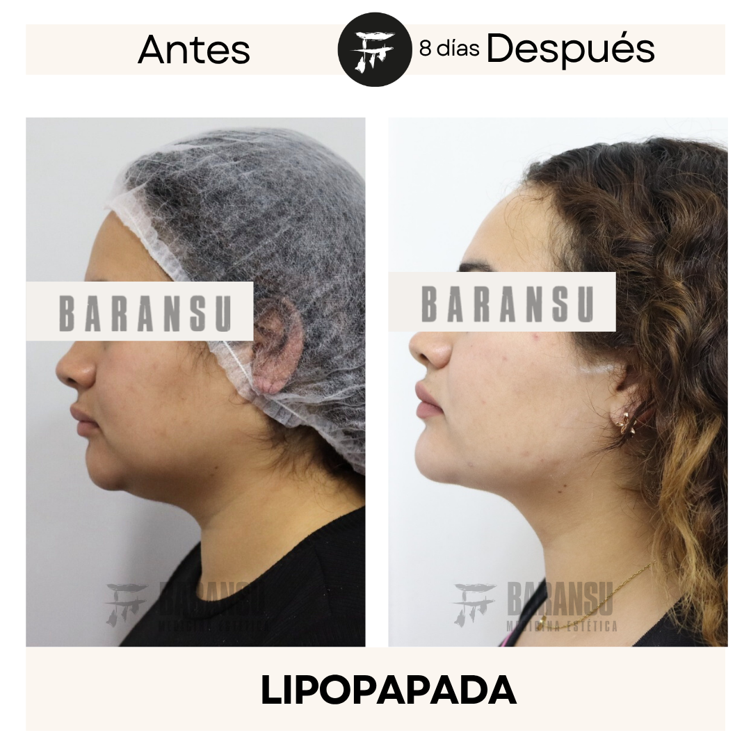 lipo de papada 15