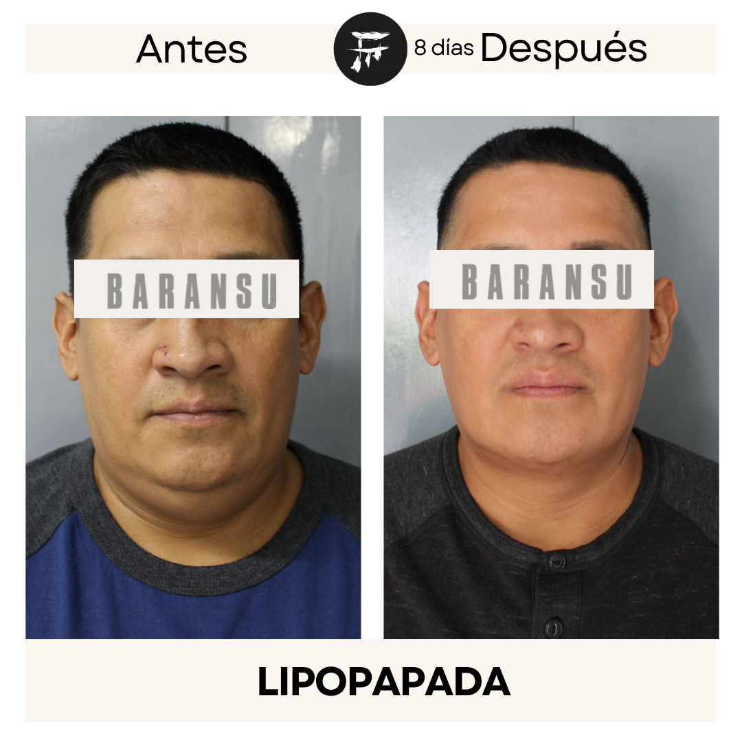 lipo de papada 16