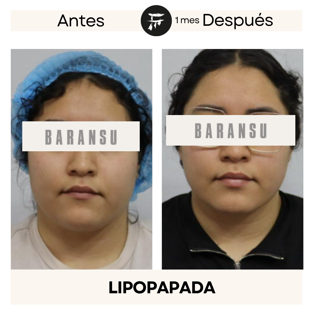 lipo de papada 17