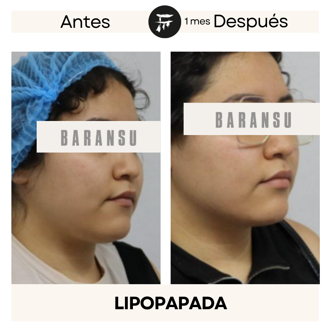 lipo de papada 18