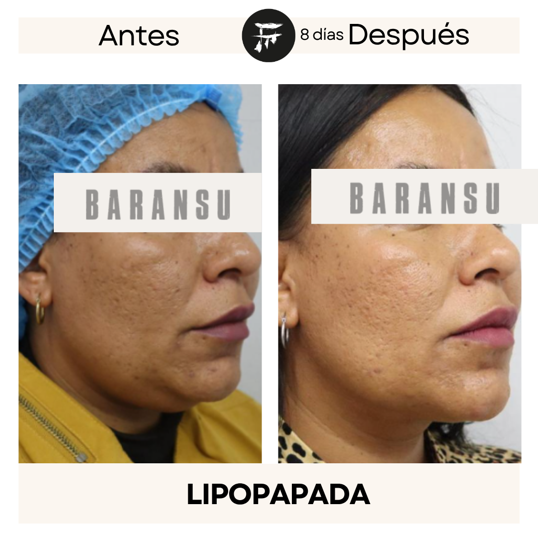 lipo de papada 19