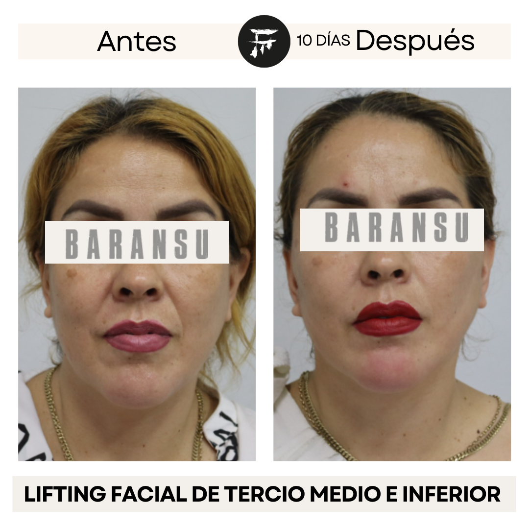 lifting facial 0