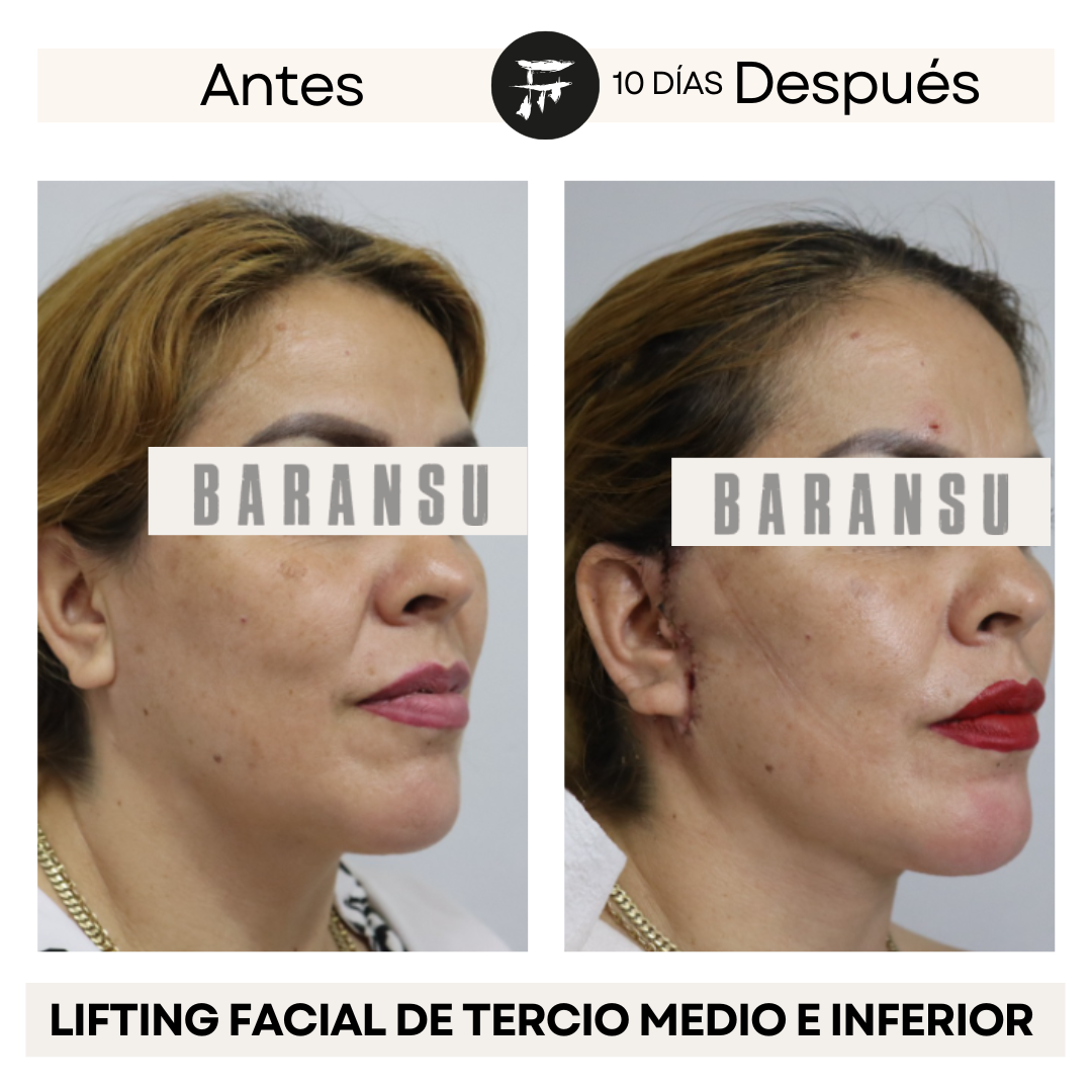 lifting facial 1