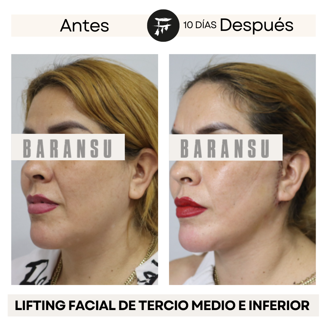 lifting facial 2