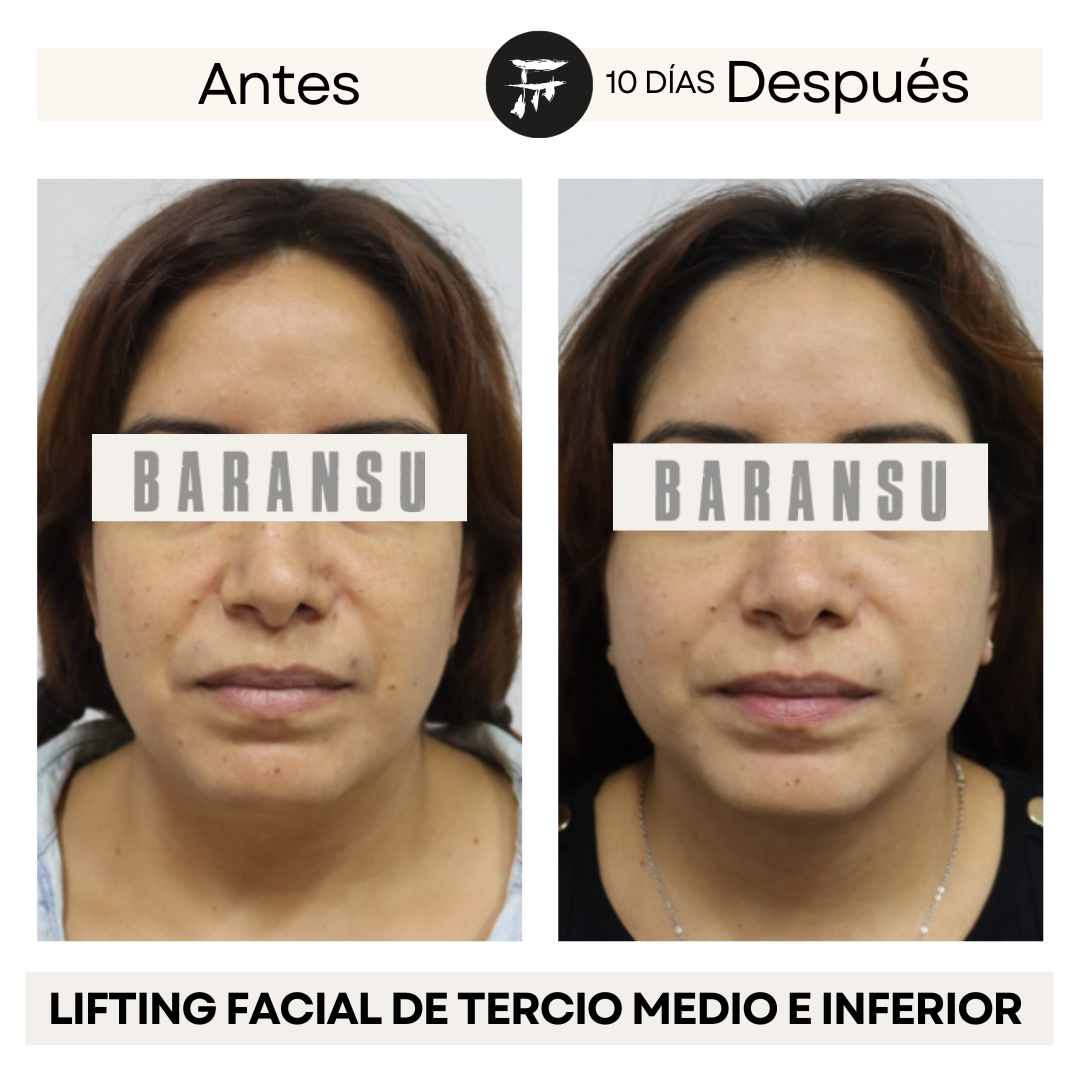 lifting facial 3