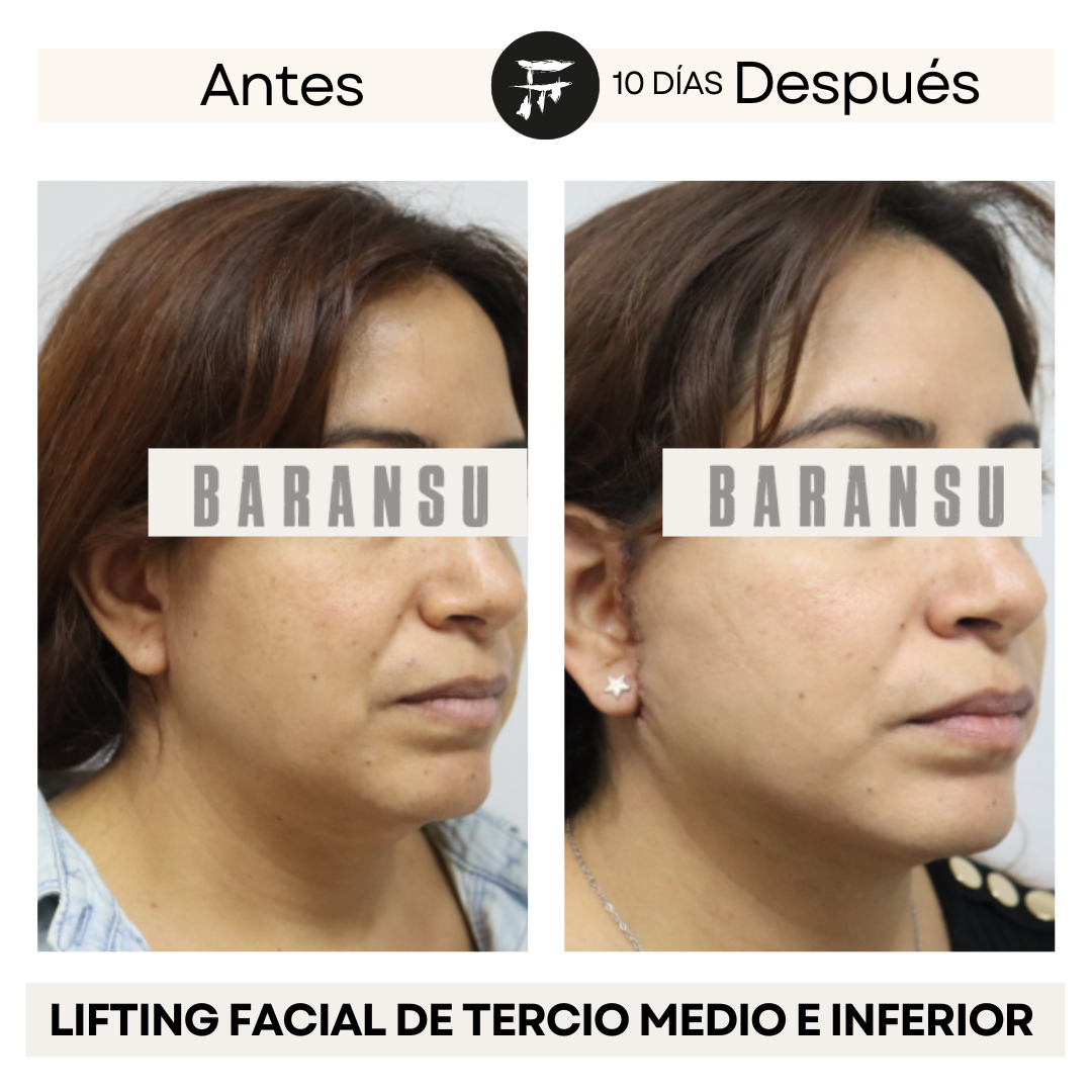 lifting facial 4