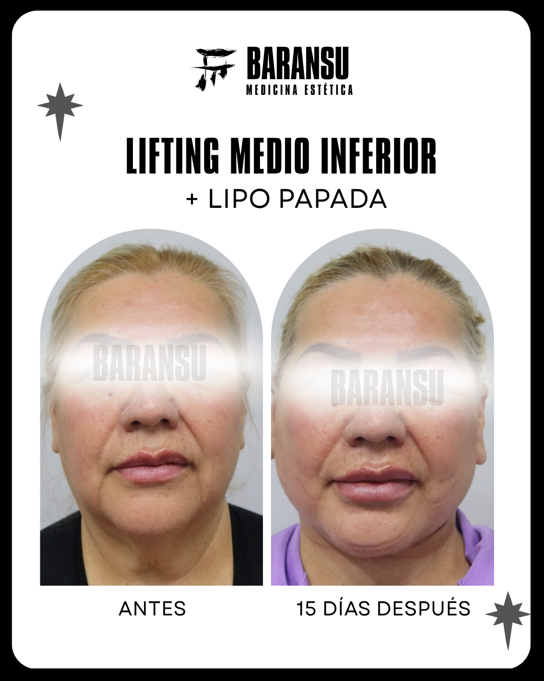 lifting facial 5