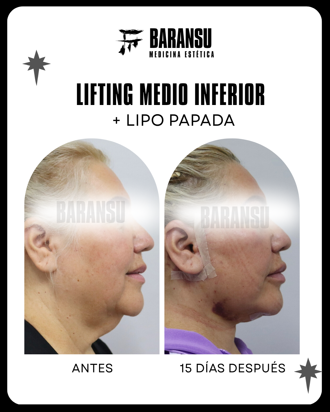 lifting facial 6