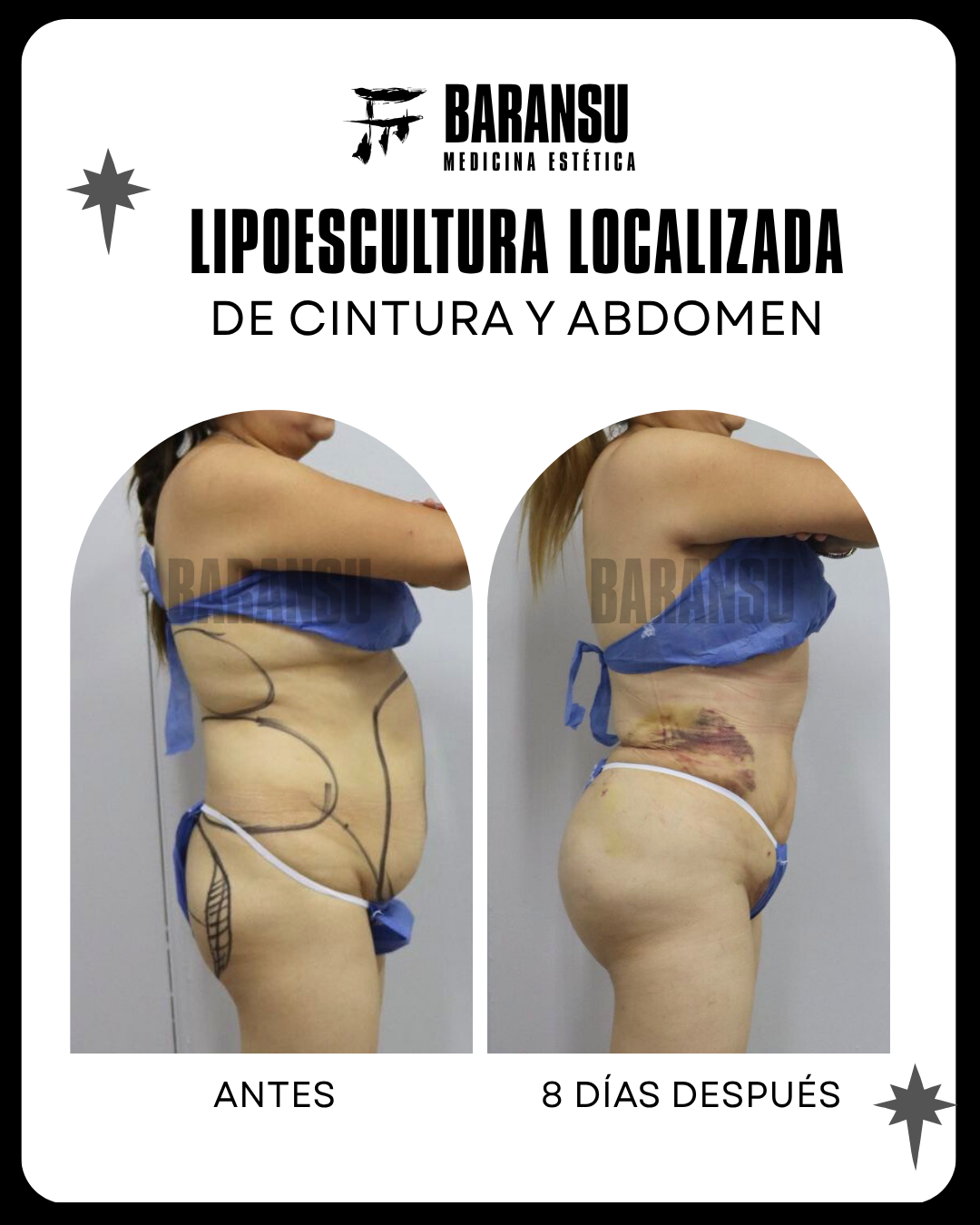 lipoescultura localizada (minilipo) 0