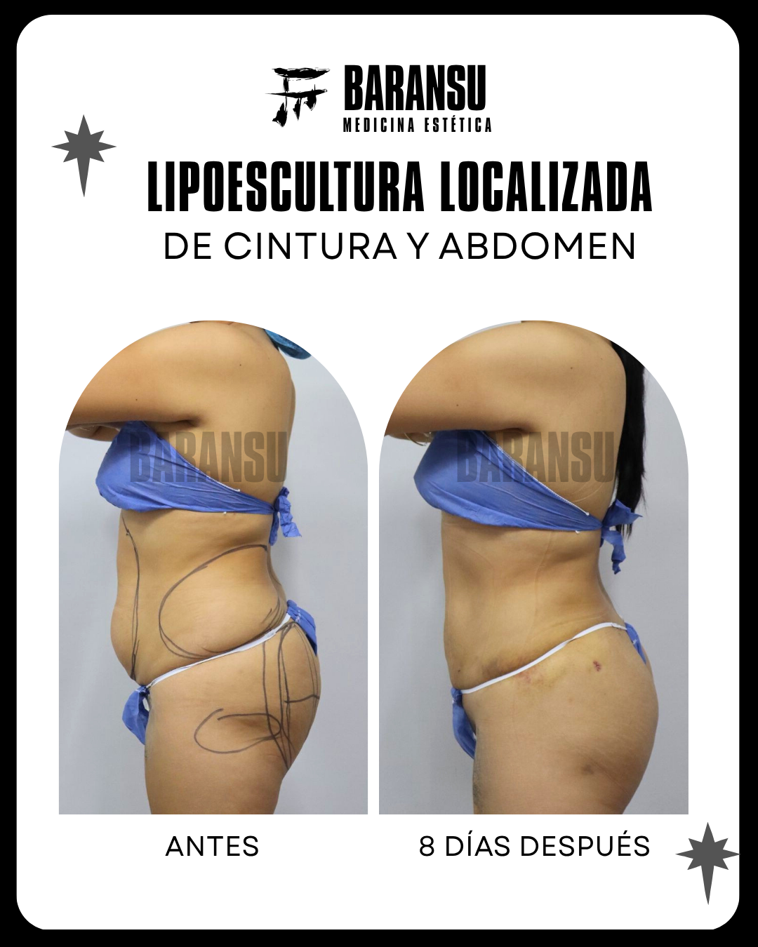 lipoescultura localizada (minilipo) 3