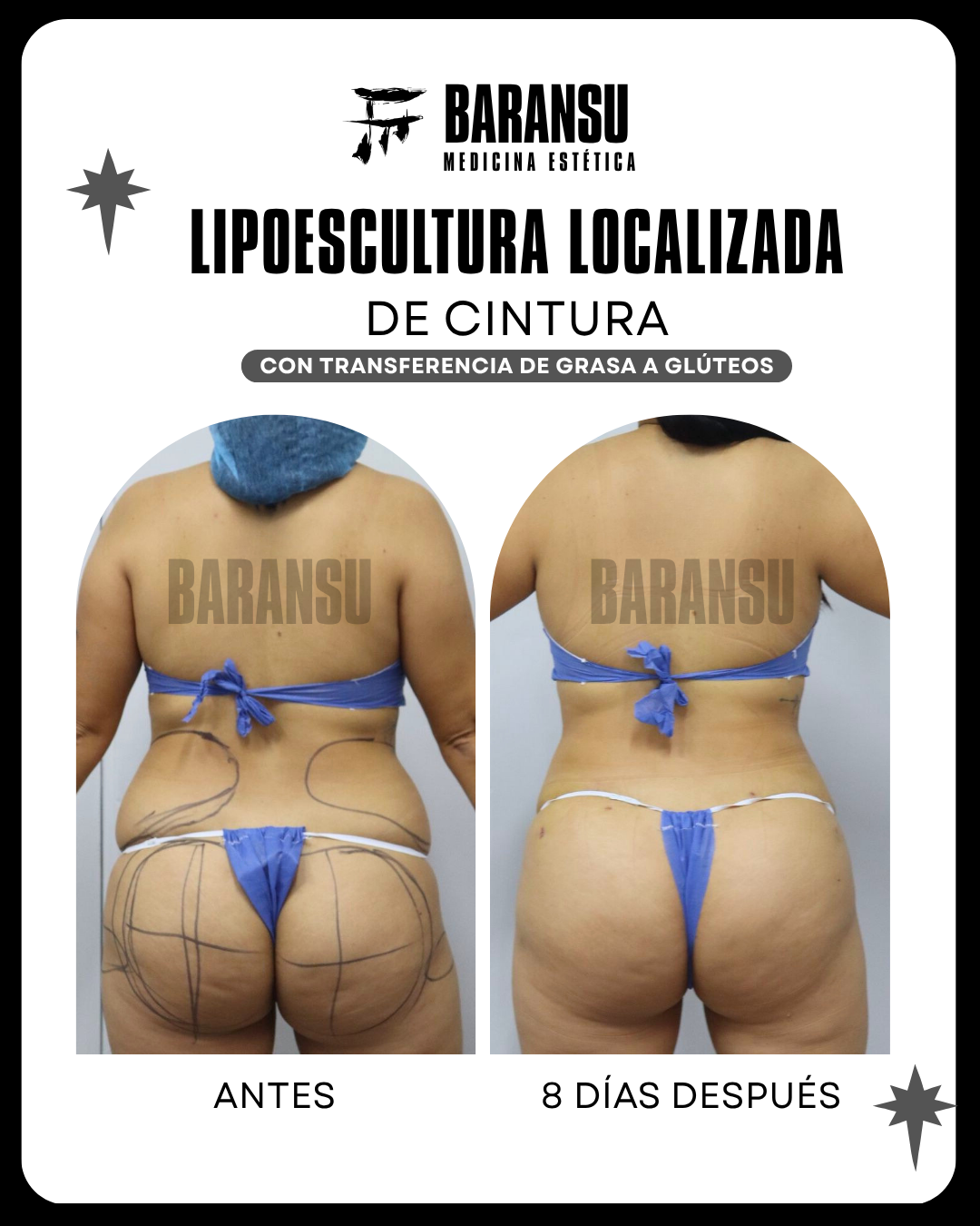 lipoescultura localizada (minilipo) 4