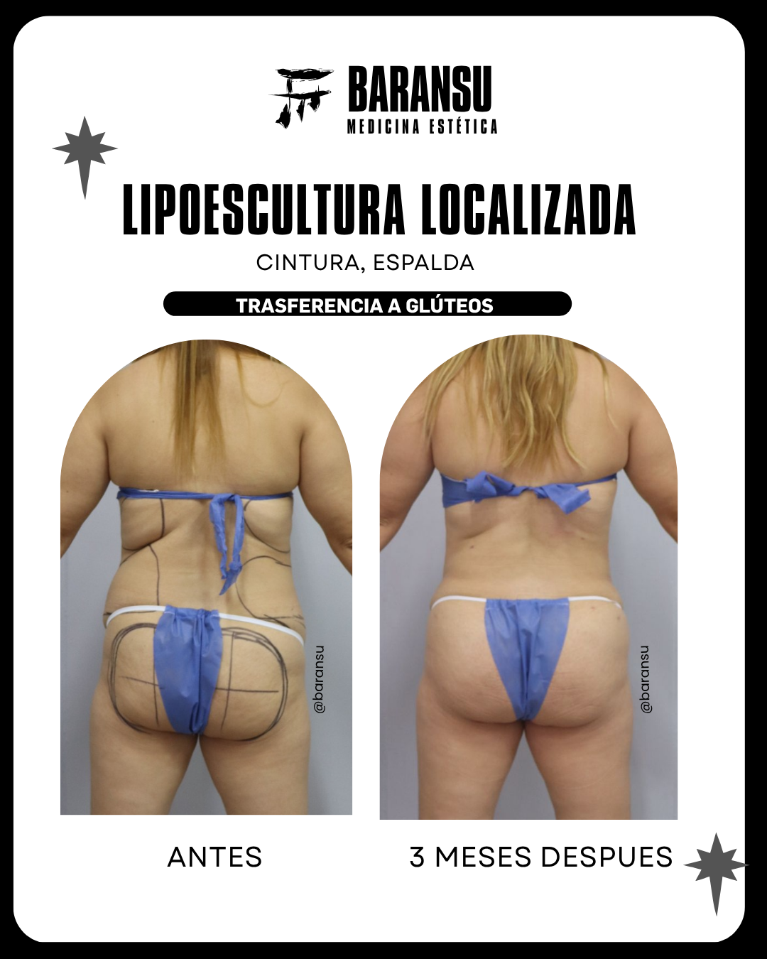 blefaroplastia 0