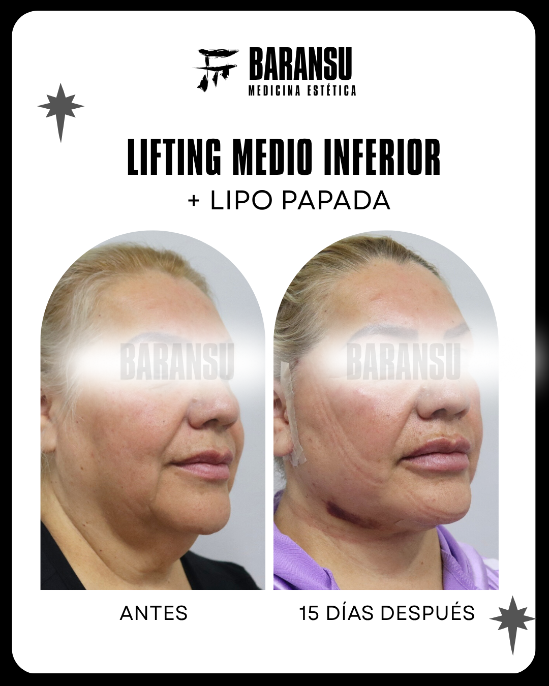 lifting facial 7