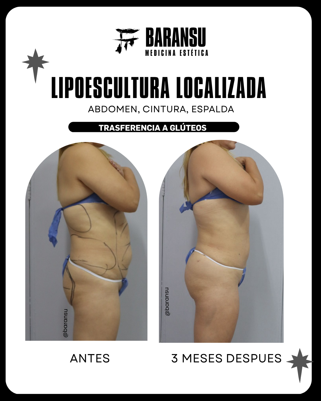 blefaroplastia 3