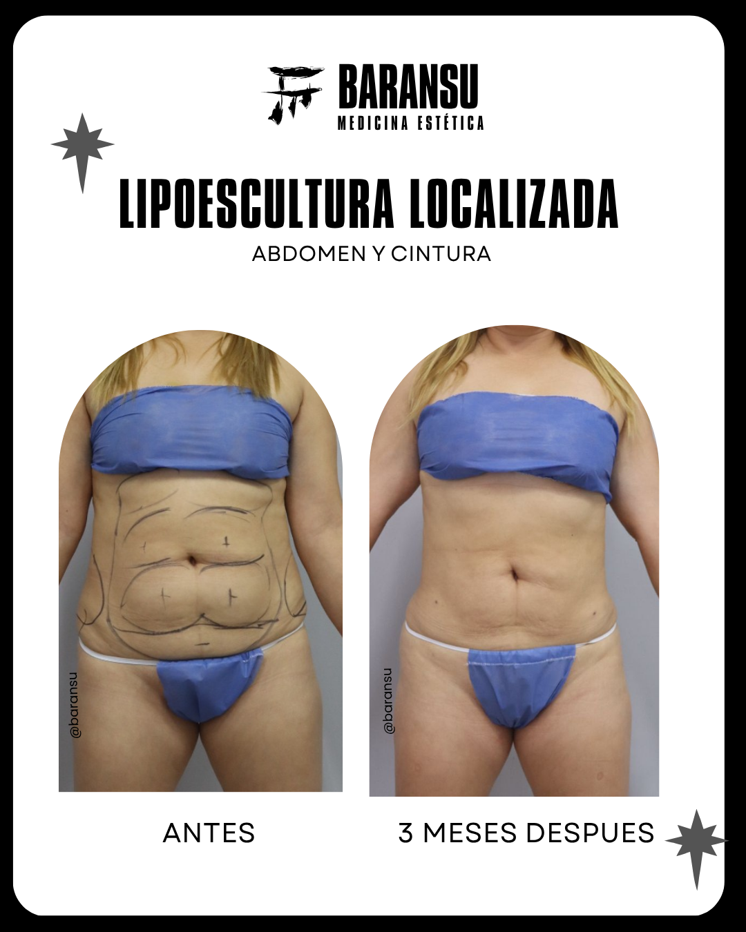 blefaroplastia 4