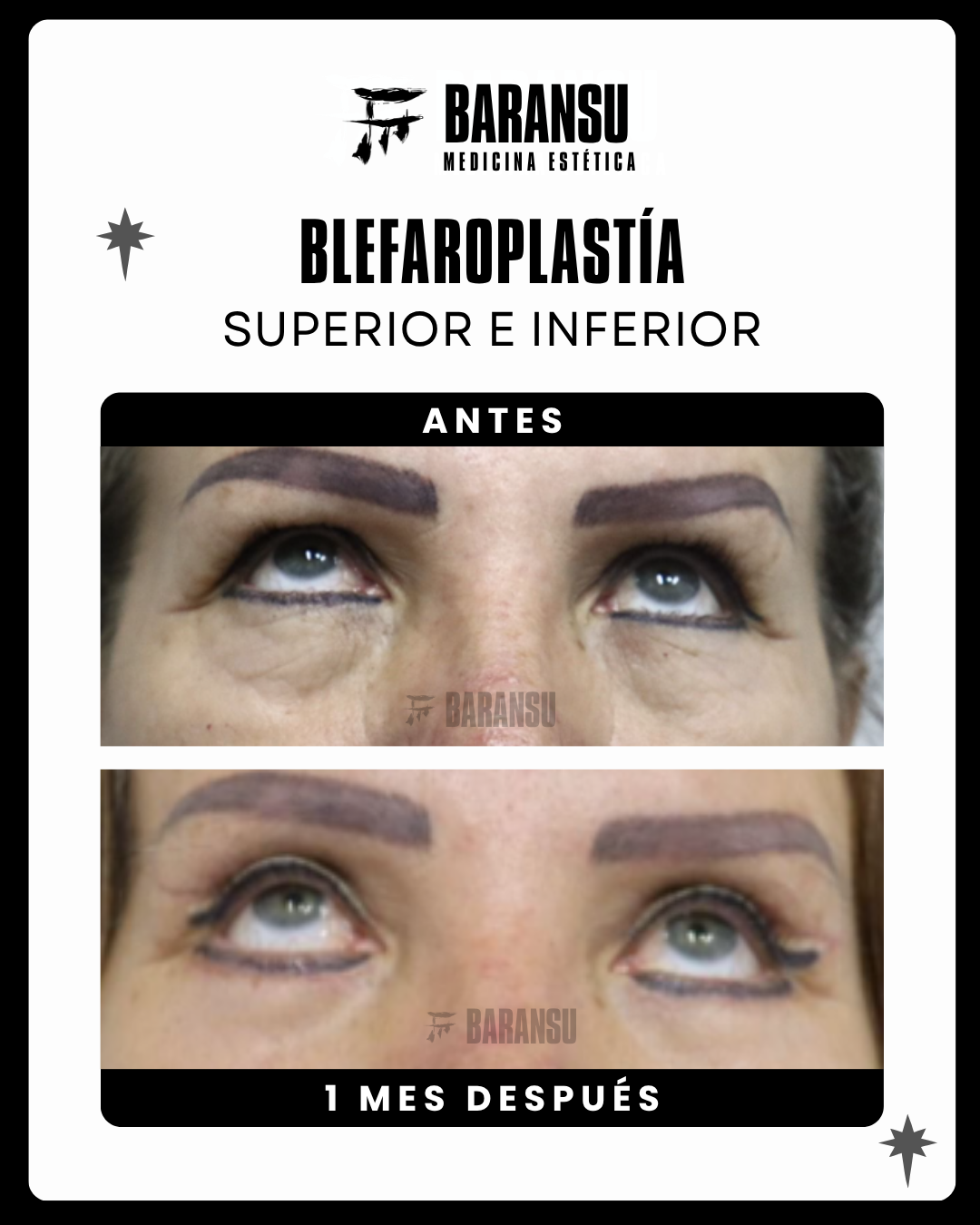 blefaroplastia 5