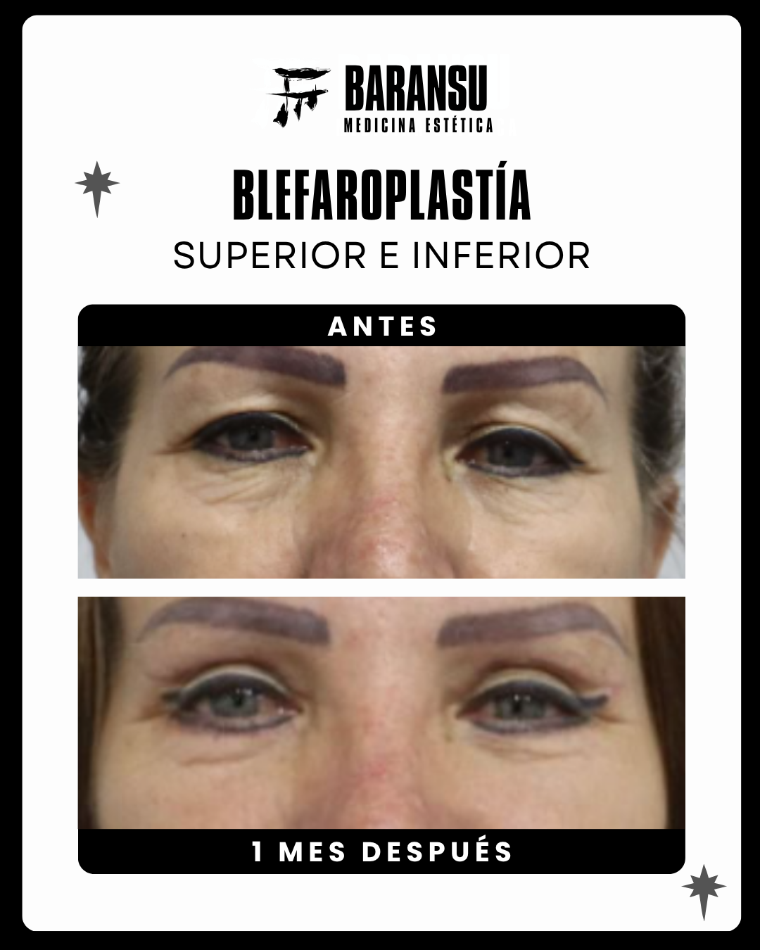 blefaroplastia 7