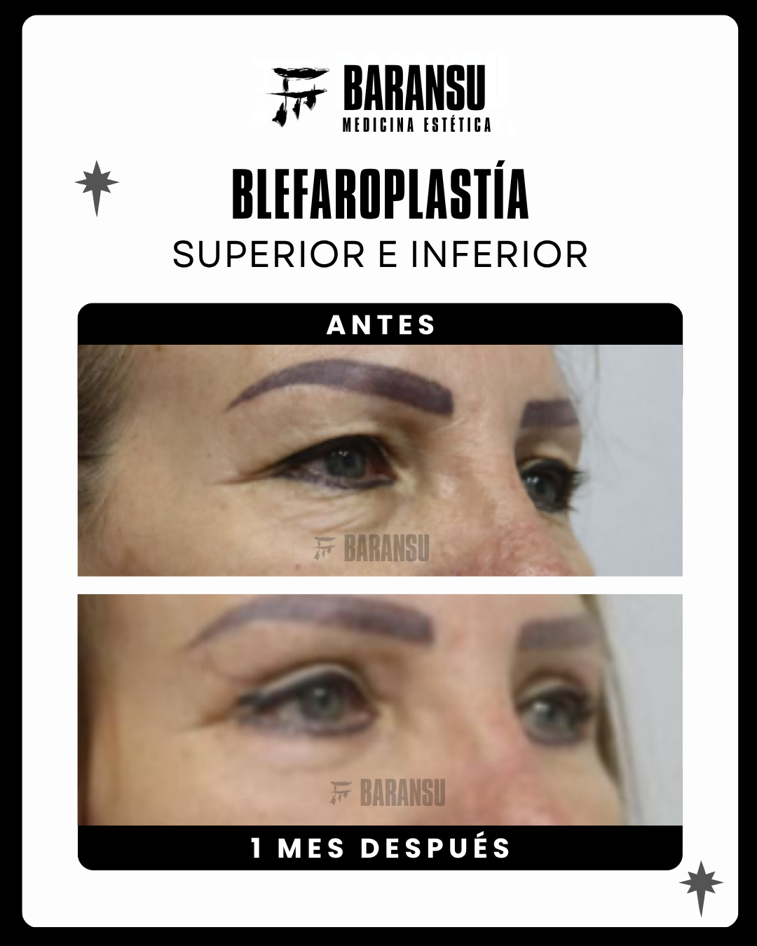 blefaroplastia 8