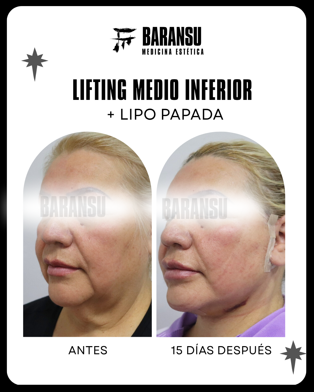 lifting facial 8