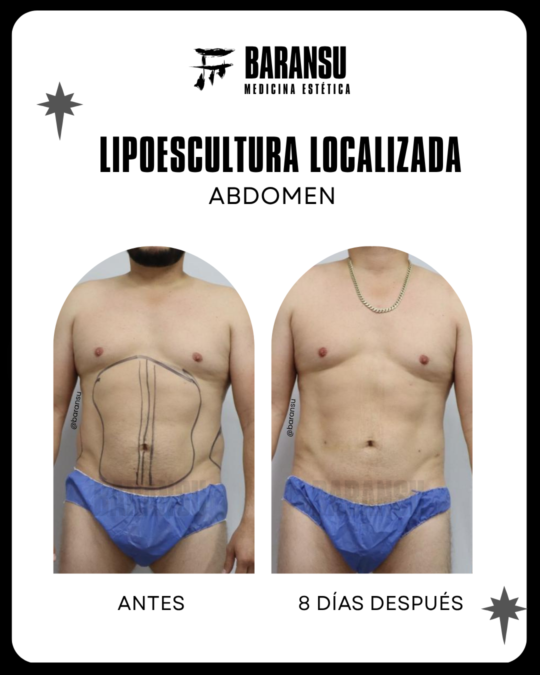 blefaroplastia 13