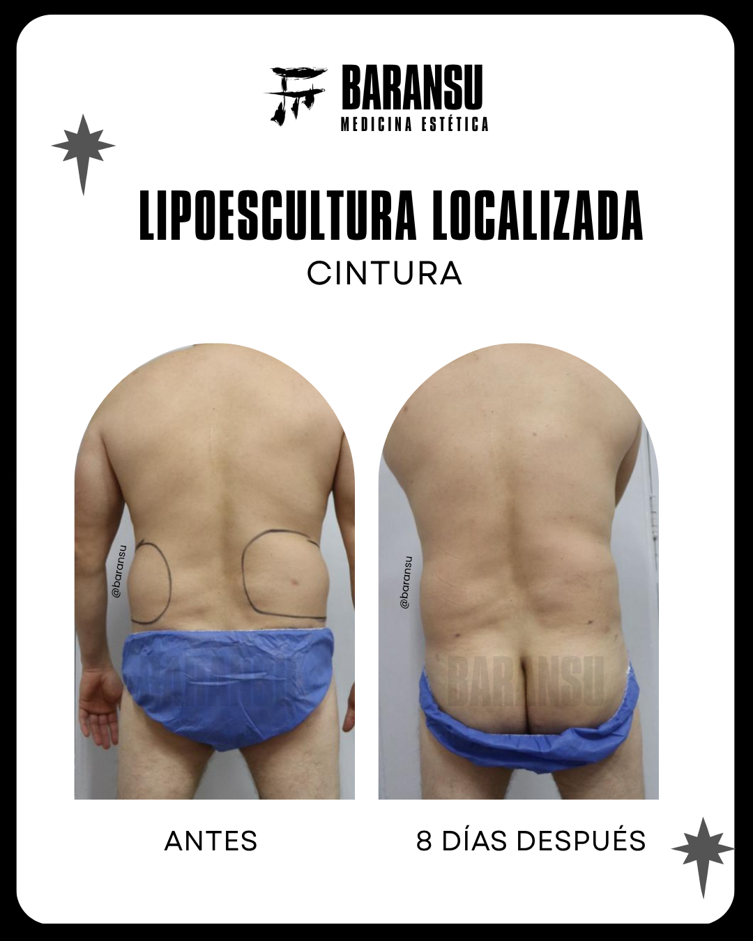 blefaroplastia 14