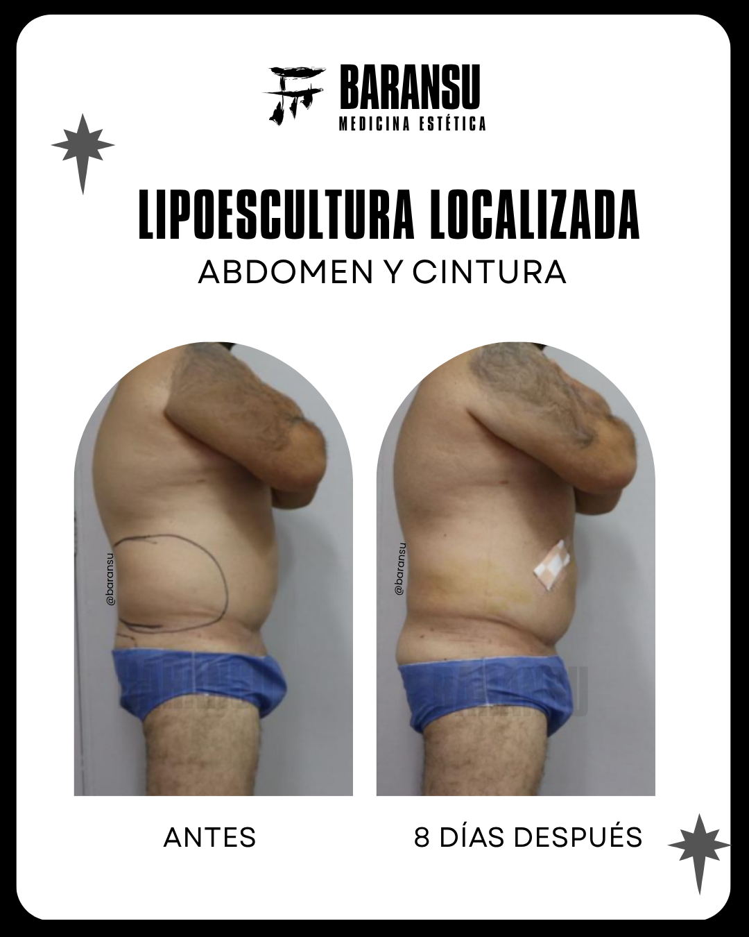 blefaroplastia 15