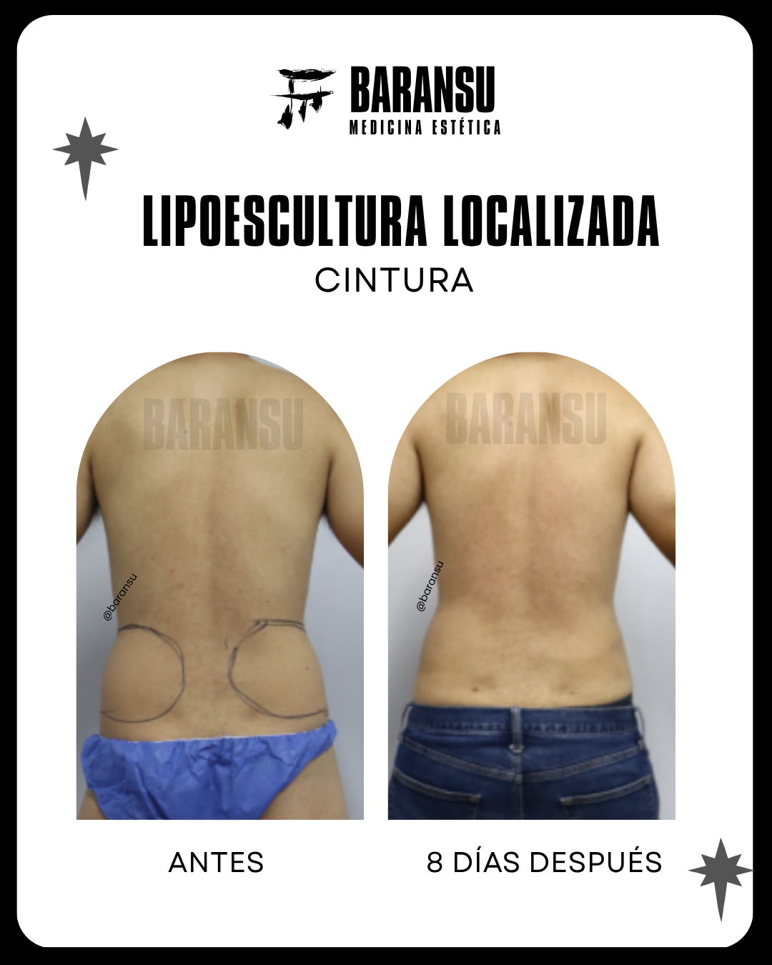 blefaroplastia 16