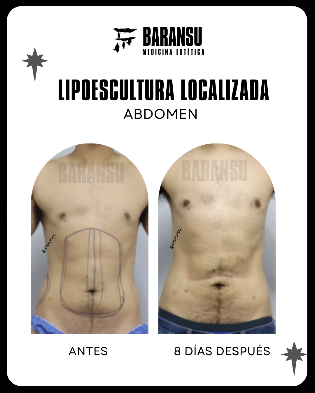blefaroplastia 17