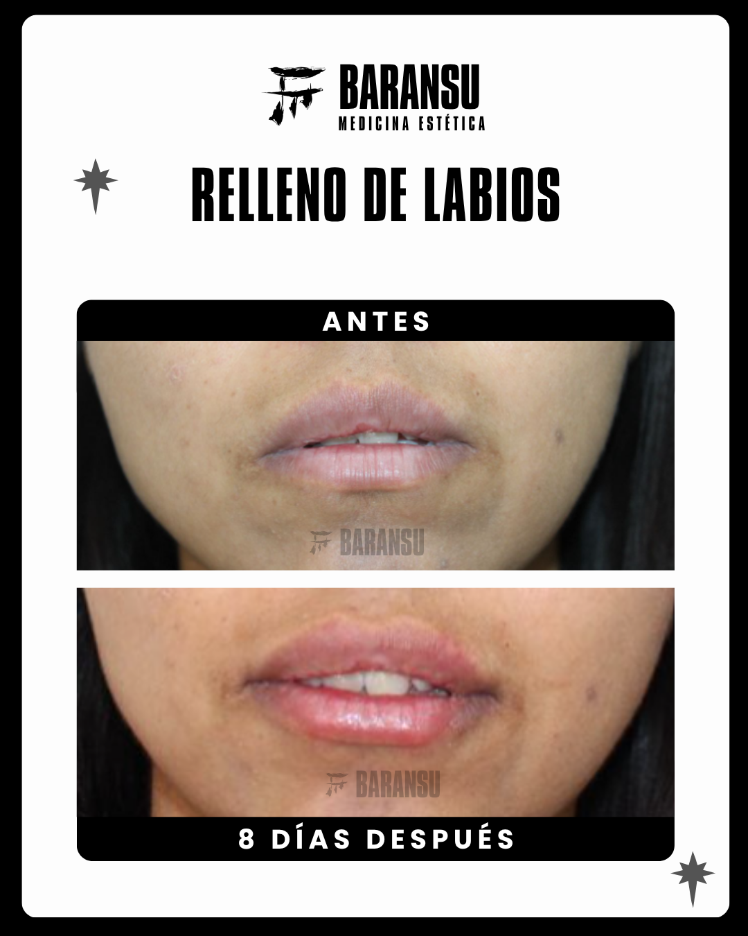 blefaroplastia 18