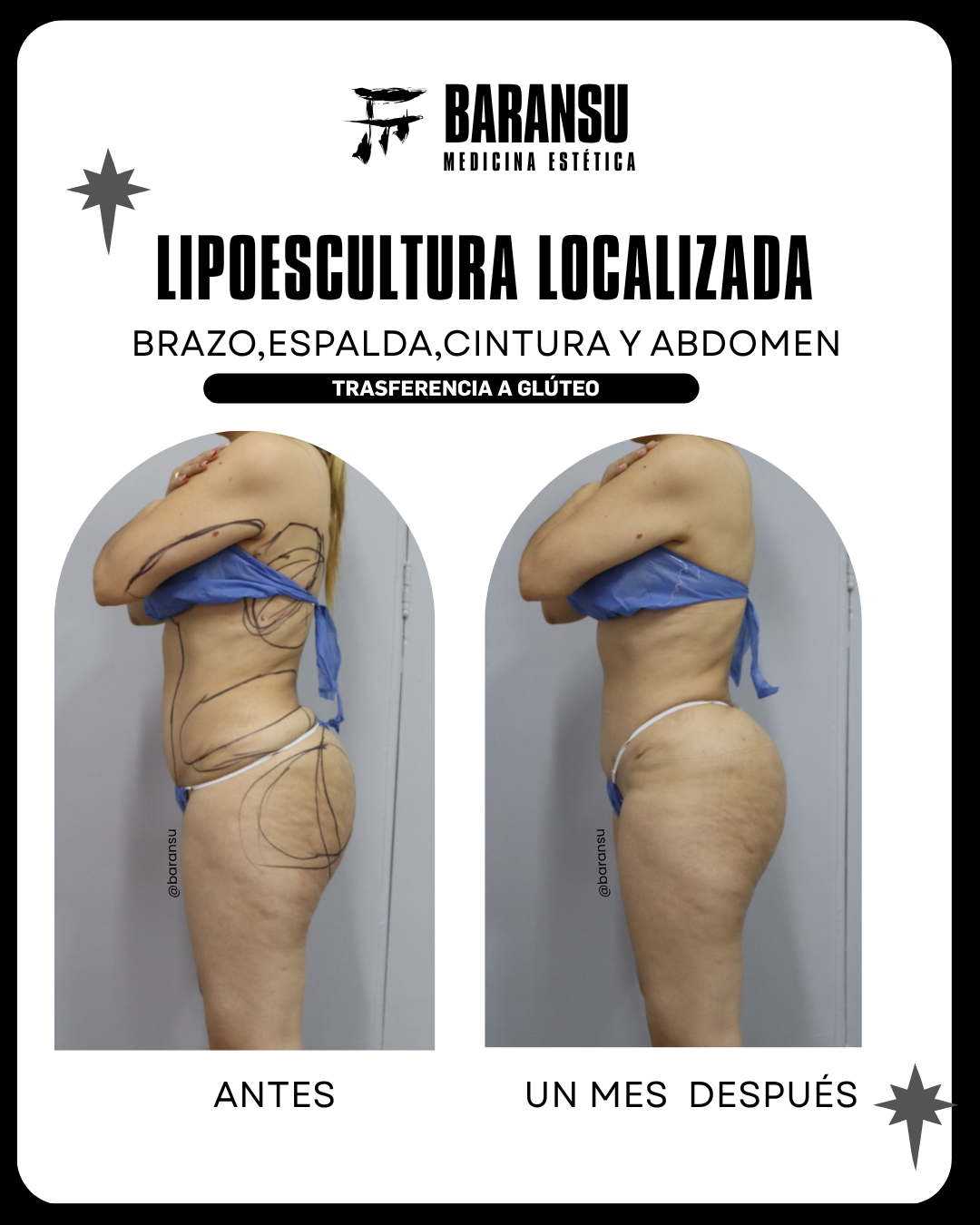 blefaroplastia 19
